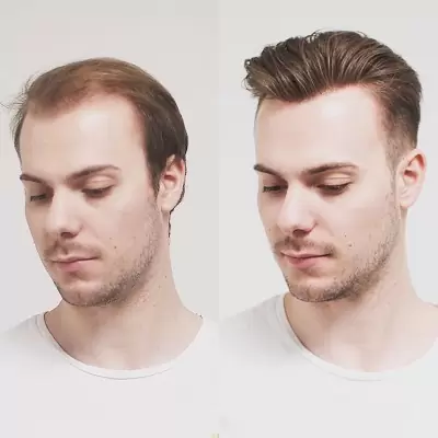 Best Hair Transplant in Islamabad